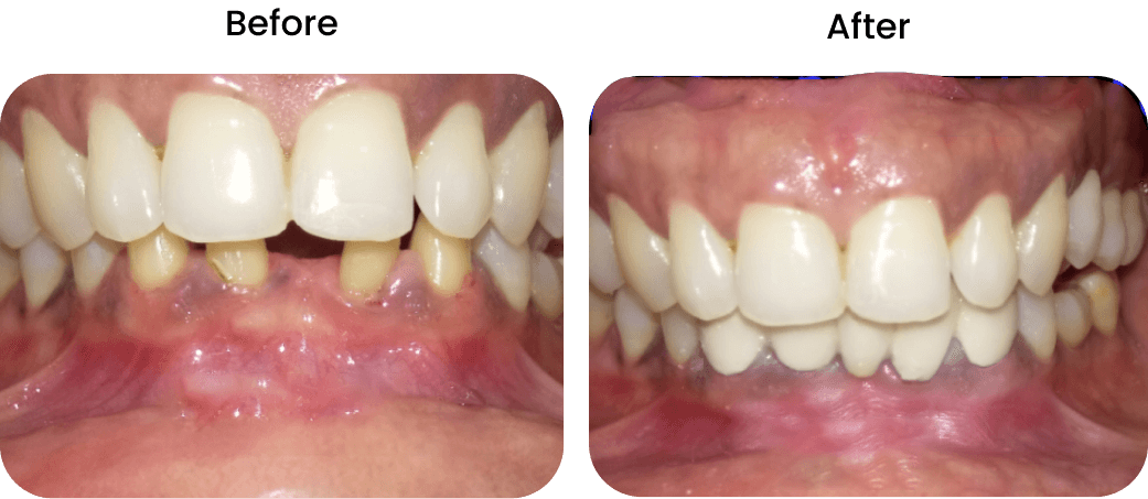 Best Dental Implants in Chennai